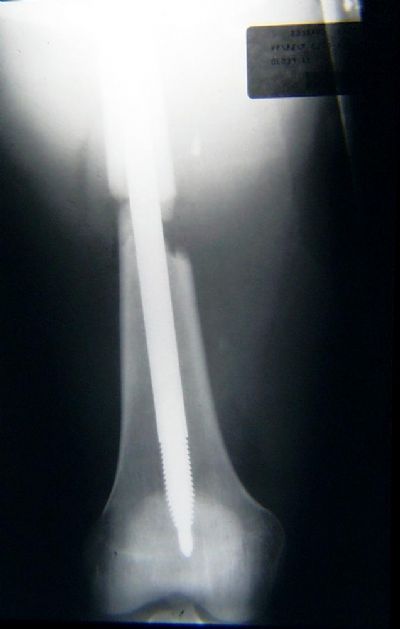 Schneider Rod (Implant 270)